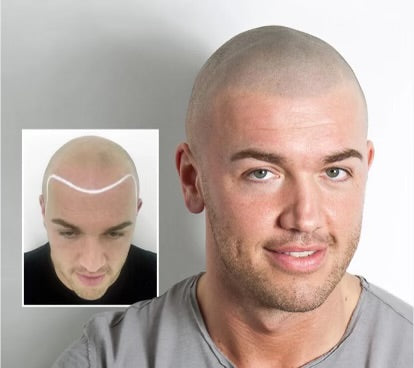 SMP/Scalp Micropigmentation